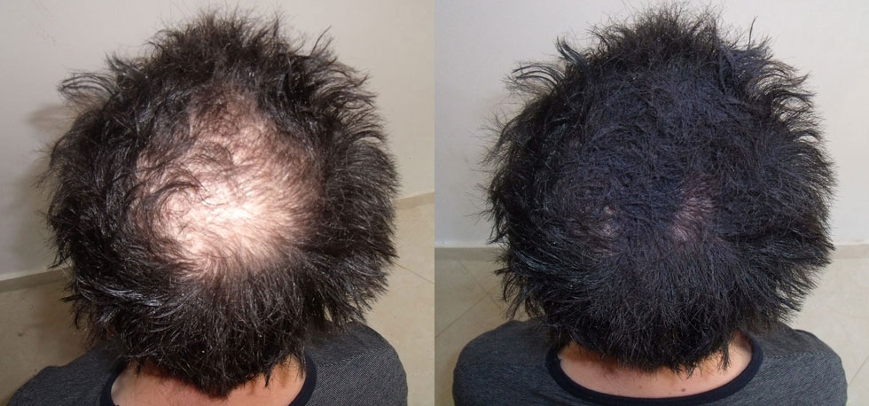 can mustard oil regrow hair